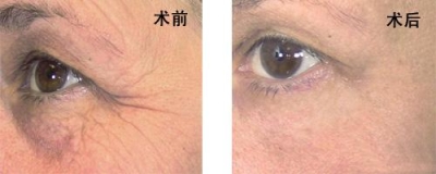 去鱼尾纹的招数,让心灵之窗绽放睛彩