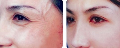 去鱼尾纹的招数,让心灵之窗绽放睛彩