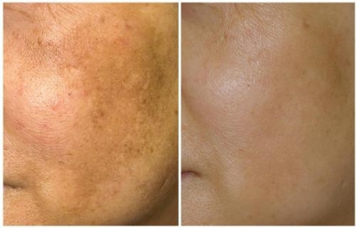 【艺星祛斑】激光治疗老年斑,几次看到效果