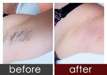 超冰脱毛,就是要让你轻松脱