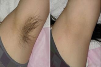 超冰脱毛,就是要让你轻松脱