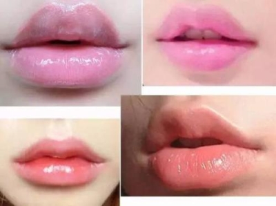 玻尿酸丰唇,开启美唇时代