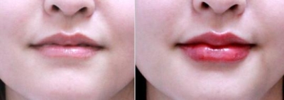 玻尿酸丰唇,开启美唇时代