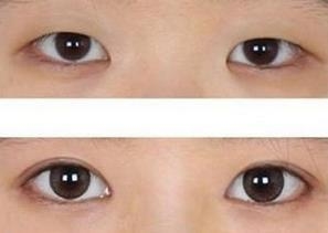 开眼角的魅力,区别就是这么大