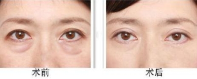 去眼袋的好机会来了,再也不用担心价格的问题了