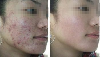 痘痘久治不愈的原因?北京艺星为你解答