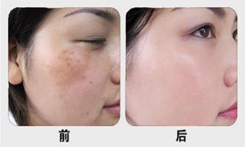 激光祛除晒斑:美白娇容再无“斑”点杂色!