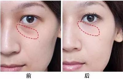 去眼袋手术恢复期要多久,你知道吗