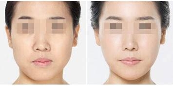 吸脂咬肌肥大缩小分享,北京面部吸脂哪家医院好