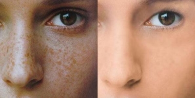 激光祛斑整形,让你做回素颜女神就在北京艺星