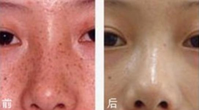 激光祛斑整形,让你做回素颜女神就在北京艺星