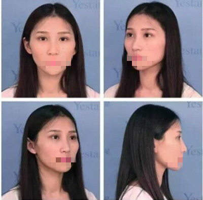 北京艺星做隆鼻哪家好?从邻家小妹变女神!带你看看魔镜