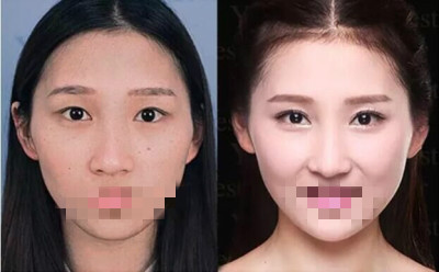 北京艺星做隆鼻哪家好?从邻家小妹变女神!带你看看魔镜