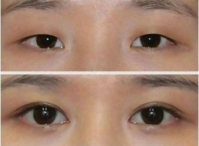 北京做开眼角价格?几乎所有的网红都做了