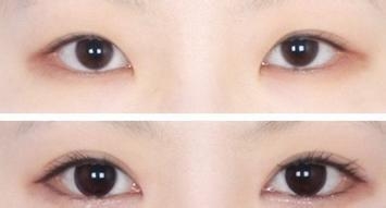 北京做开眼角价格?几乎所有的网红都做了