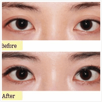 北京做开眼角价格?几乎所有的网红都做了