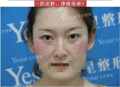 北京做皮秒激光哪里好?闺蜜素到“无妆”靓爆镜