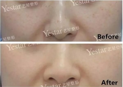 北京做皮秒激光哪里好?闺蜜素到“无妆”靓爆镜