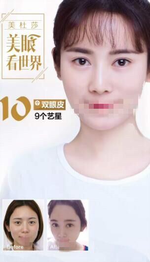 北京艺星做双眼皮前后对比照?为甜蜜加分!逆袭女神!