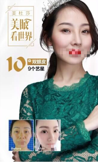 北京艺星做双眼皮前后对比照?为甜蜜加分!逆袭女神!