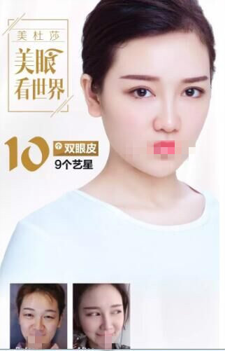 北京艺星做双眼皮前后对比照?为甜蜜加分!逆袭女神!