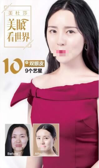 北京艺星做双眼皮前后对比照?为甜蜜加分!逆袭女神!