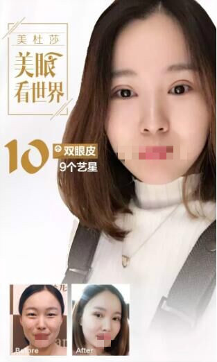 北京艺星做双眼皮前后对比照?为甜蜜加分!逆袭女神!