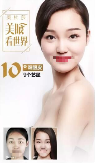 北京艺星做双眼皮前后对比照?为甜蜜加分!逆袭女神!