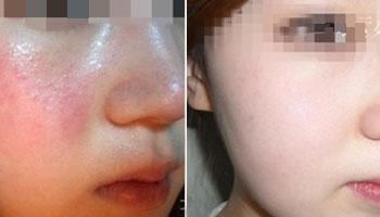 北京艺星激光祛痘要多少钱?青春更美丽!