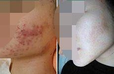 北京艺星激光祛痘要多少钱?青春更美丽!