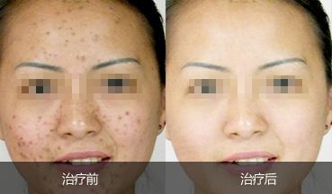 北京艺星激光祛痘要多少钱?青春更美丽!