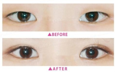 北京做双眼皮多少钱?超强攻略一秒变大眼
