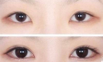 北京做双眼皮多少钱?超强攻略一秒变大眼