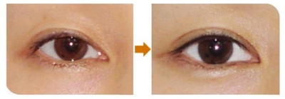 北京做双眼皮多少钱?超强攻略一秒变大眼