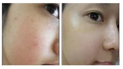 北京祛痘哪家好?遇见更美的自己