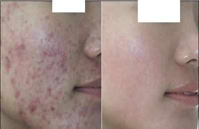 北京祛痘哪家好?遇见更美的自己