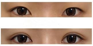 北京割双眼皮哪家效果好?妥妥的女神