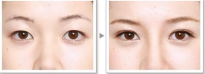 北京割双眼皮哪家效果好?妥妥的女神