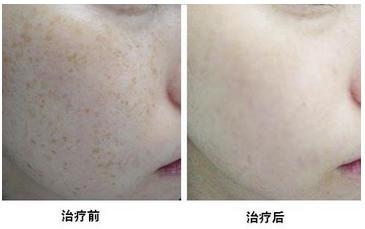 北京激光去除老年斑价格?年轻十岁,焕发光彩