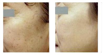 北京激光去除老年斑价格?年轻十岁,焕发光彩