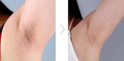 北京做激光脱毛价格?妥妥的女神范儿