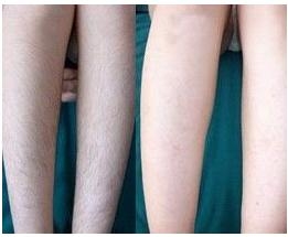 北京做激光脱毛价格?妥妥的女神范儿