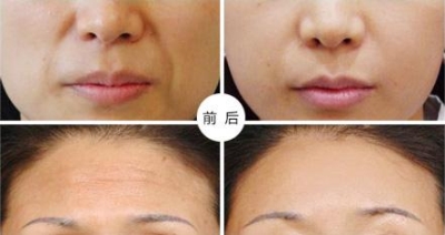 北京做自体脂肪填充效果？脂肪变“肥”为宝
