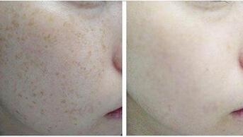 北京治疗雀斑那家医院好?雀斑简直不能忍