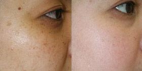 北京治疗雀斑那家医院好?雀斑简直不能忍