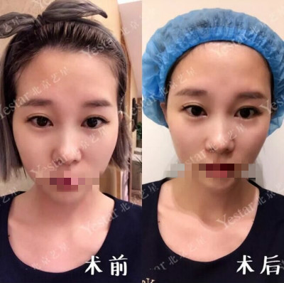 北京玻尿酸哪家医院好?变美不是靠运气