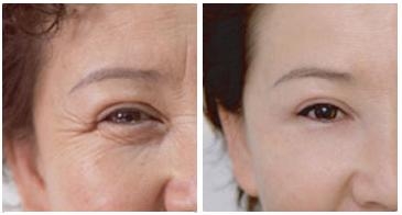 北京爱贝芙除皱效果怎么样?让您比同龄的她年轻