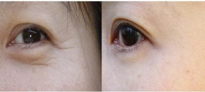 北京爱贝芙除皱效果怎么样?让您比同龄的她年轻