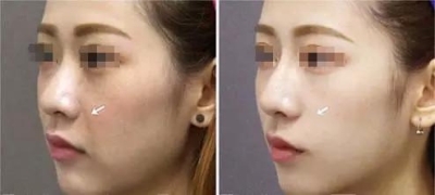 北京做的费用是多少?为什么这么受欢迎