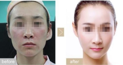 北京做的费用是多少?为什么这么受欢迎